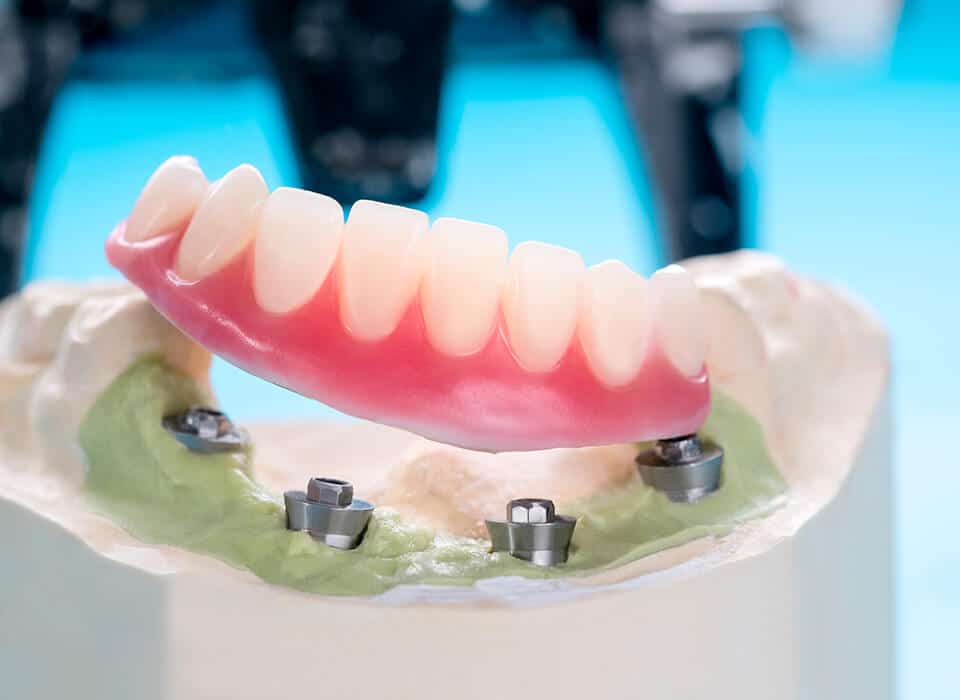 All-On-Four Denture Alternative