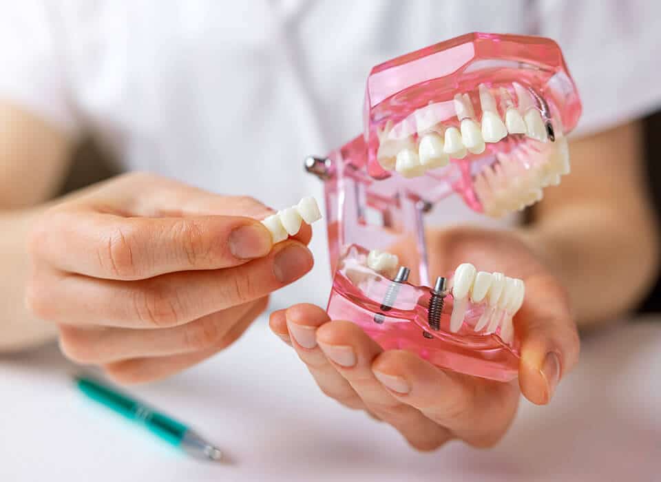 dental bridges supported on implants