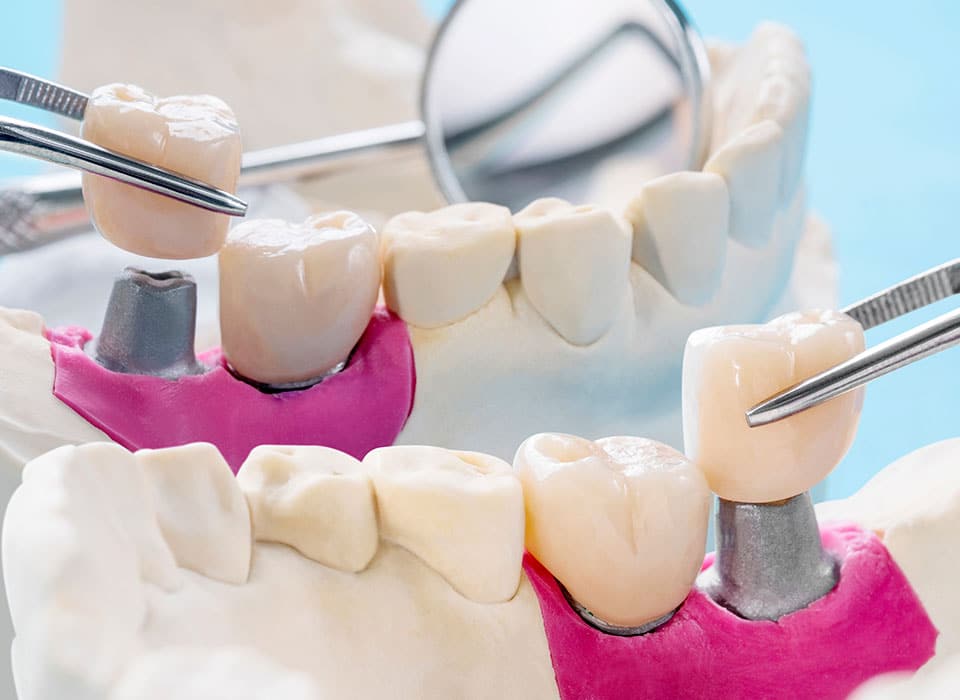 model of crowns on dental implants