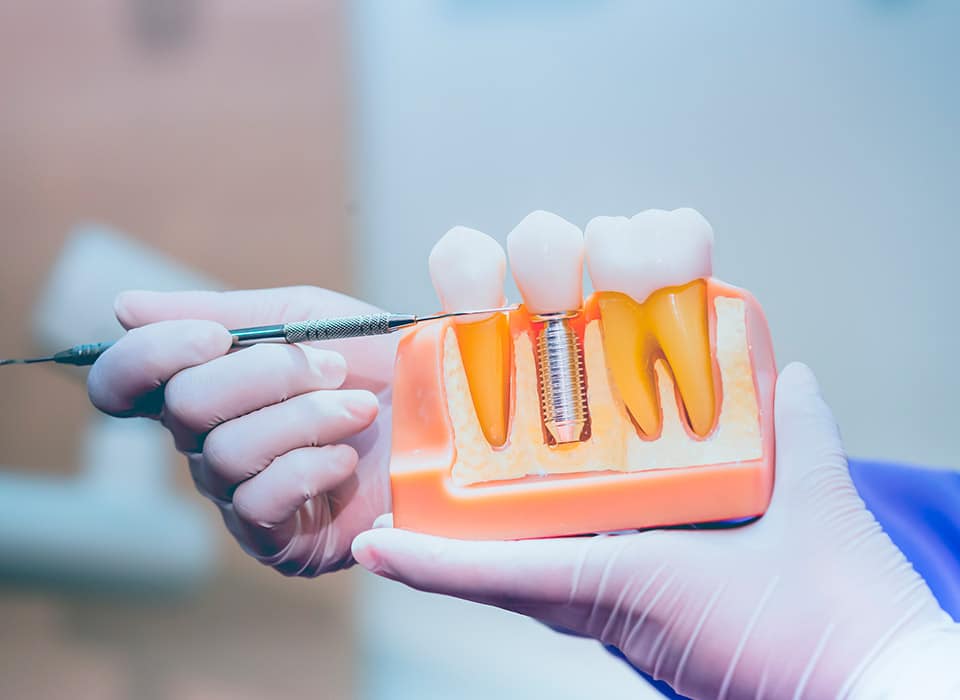 model of dental implant