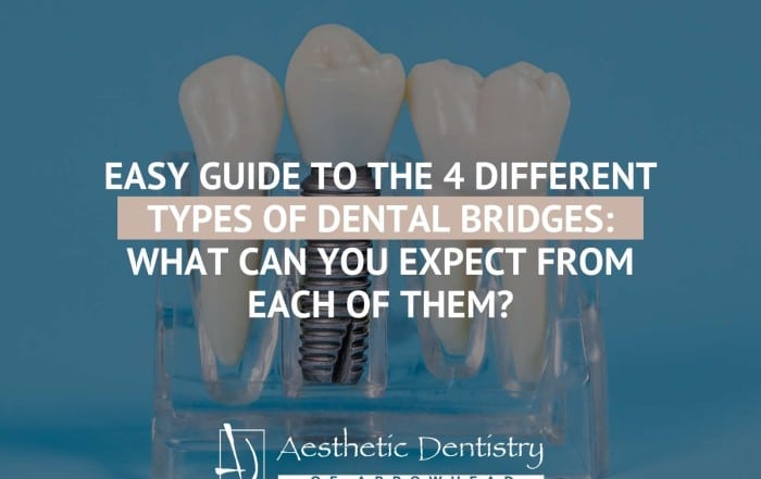 Easy Guide To The 4 Different Types of Dental Bridges