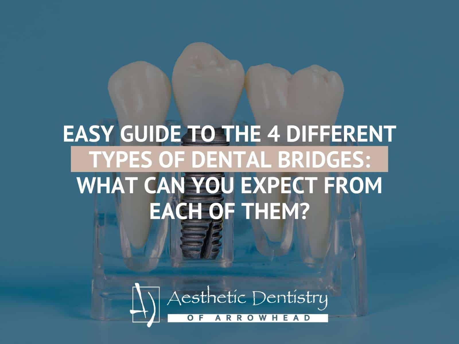 Easy Guide To The 4 Different Types of Dental Bridges