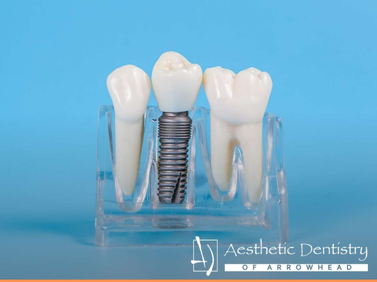 Easy Guide To The 4 Different Types of Dental Bridges