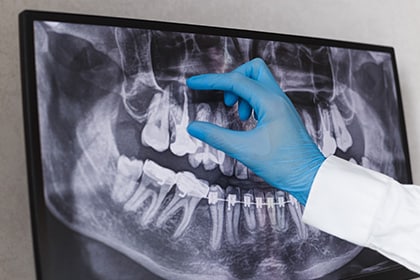 Quality Tooth Implants On Dental X-Ray