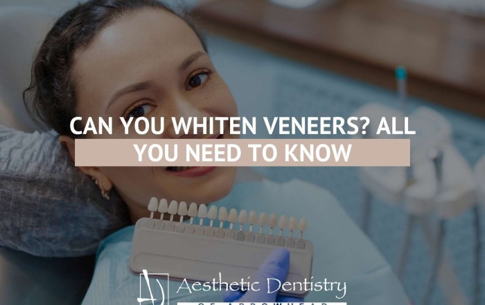 Can You Whiten Veneers All You Need To Know