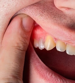 Genetic Factors Could Increase Your Susceptibility to Periodontitis