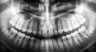 Step 1: Teeth, Gum And Jawbone Evaluation