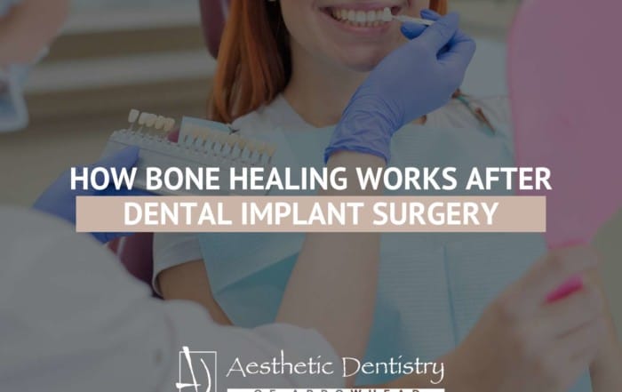How Bone Healing Works After Dental Implant Surgery
