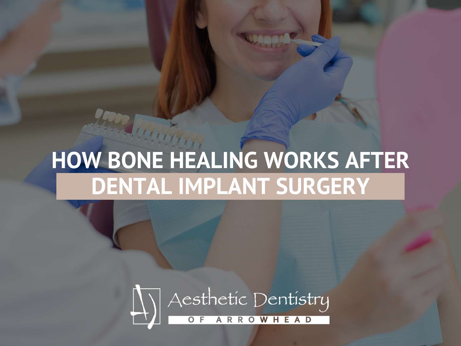 How Bone Healing Works After Dental Implant Surgery