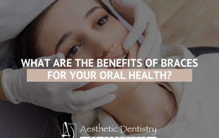 What Are The Benefits Of Braces For Your Oral Health