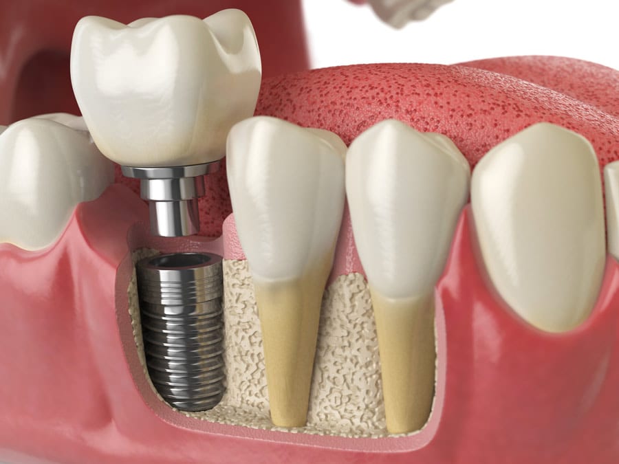 Dental Implant Abutment And Attachment Of Crown