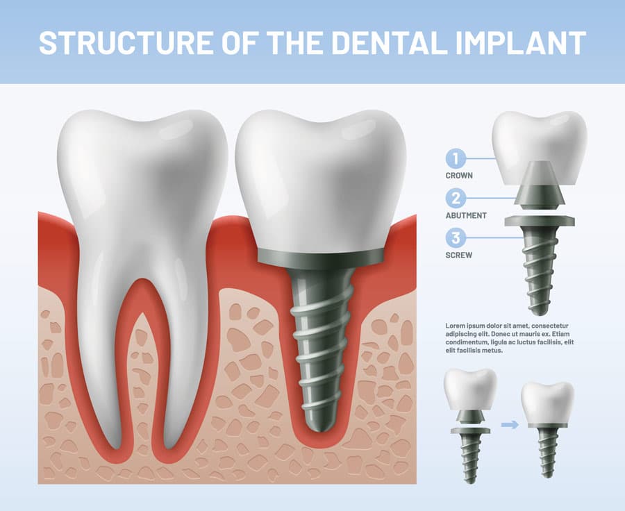 Structure Of A Dental Implant