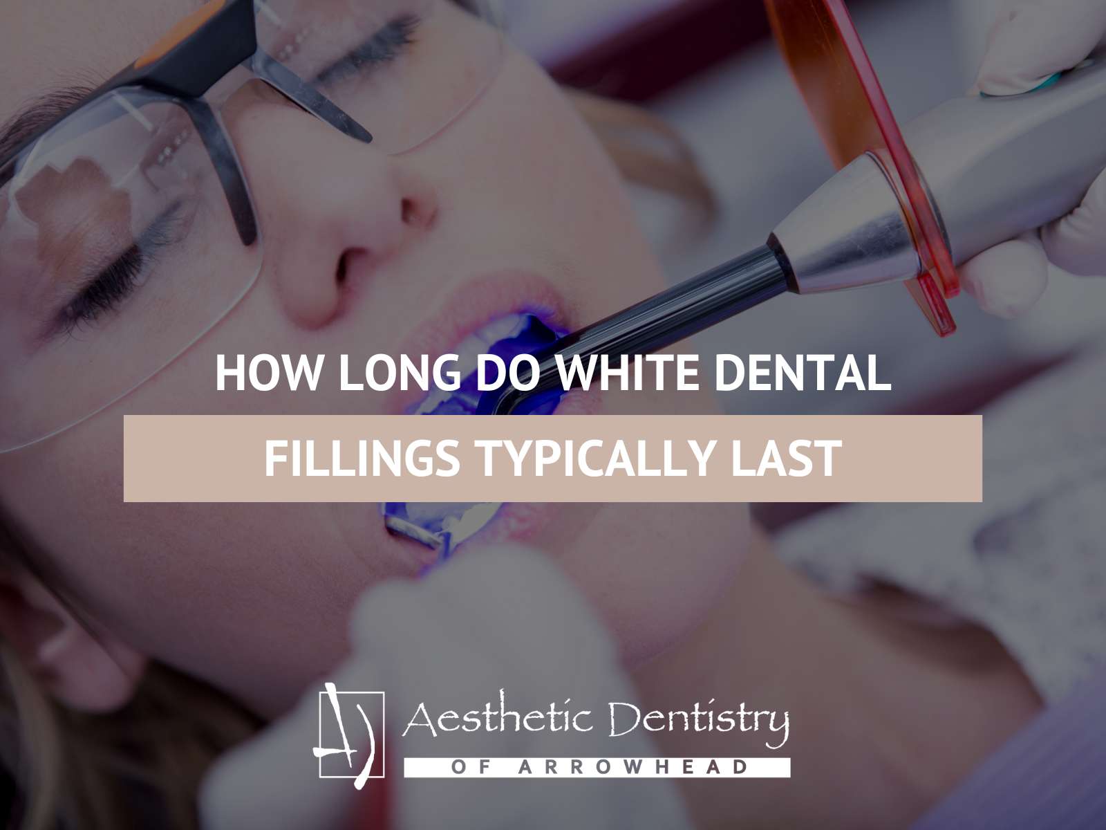 How Long Do White Dental Fillings Typically Last