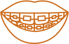 Self-Ligating Braces Adjustments in Peoria
